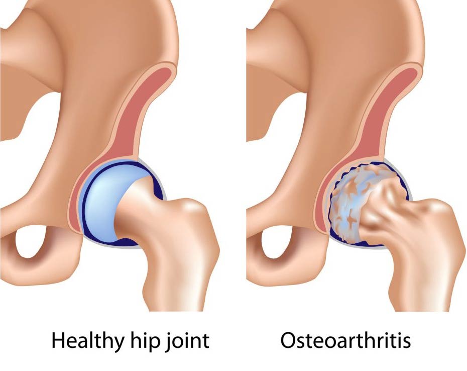 How do Rheumatoid Arthritis and Osteoarthritis differ?